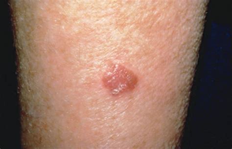 Signs Of Skin Cancer This Skin Check Can Save Your Life Glamour Free