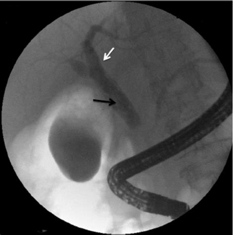 Ercp Has Showed Dilatation Of Common Bile Duct White Arrow With