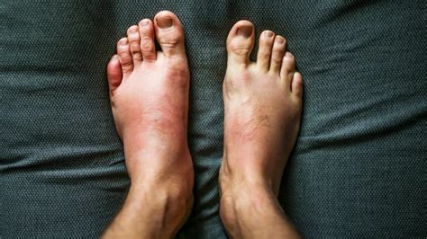 Swelling Is It Serious Symptoms Causes And Treatment