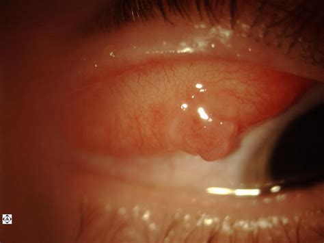 Granuloma Forming Around A Palpebral Conjunctival Foreign Body