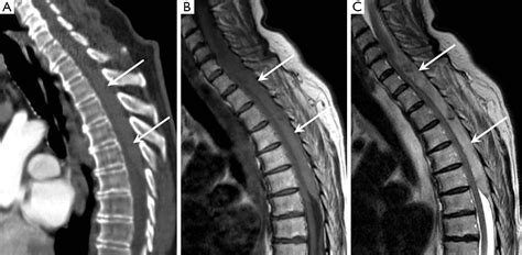 Spontaneous Spinal Epidural Haematoma Mimicking Acute Coronary Syndrome