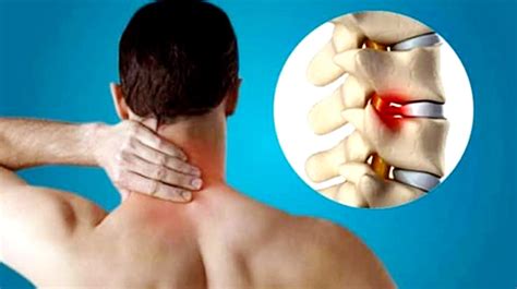 Cervical Spondylosis What Are Its Symptoms And Treatment Arun Bhanot