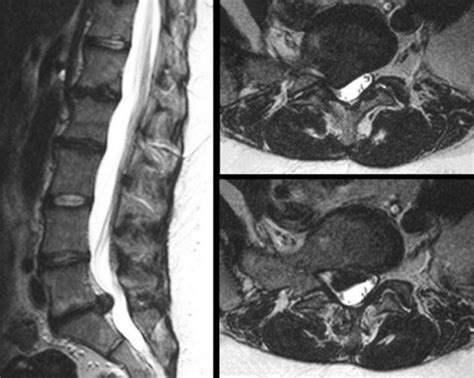 .lumbar magnetic resonance imaging (mri) for the automatic detection of abnormalities and we proposed a robust method to detect herniated lumbar disc. Herniated Disk