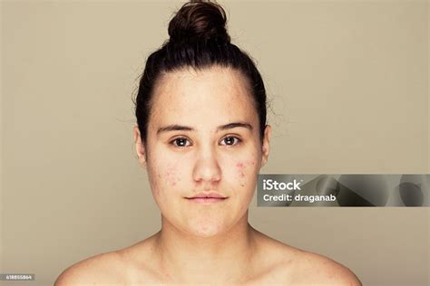 Teenage Skin Stock Photo Download Image Now Acne Teenage Girls