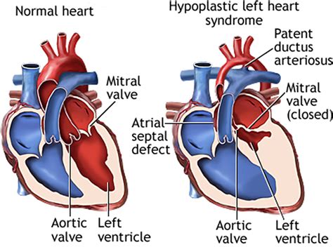 Hypoplastic Left Heart Syndrome Causes Prognosis Surgery Treatment