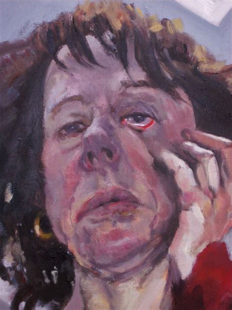Retinal tears develop when the vitreous pulls on the retina while retinal holes develop due to if a retinal tear is diagnosed promptly before it progresses to retinal detachment, the prognosis is. Self Portrait with torn retina - Jane Kelly