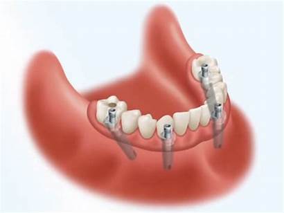 Dental Implants Dentures Hybrid Implant Retained Surgery