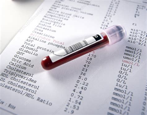 Blood Sample With Results Stock Image M5300476 Science Photo Library