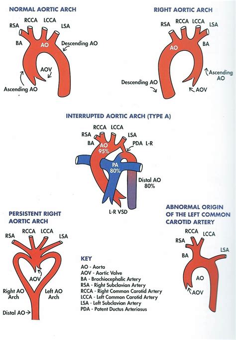 Diagram Of Development Of Right Aortic Arch With Aberra Open I My XXX