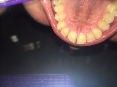 The epstein pearls are bumps occurring in the mouth of newborns or very young kids. I have bumps on the back of my tongue, the roof of my mouth