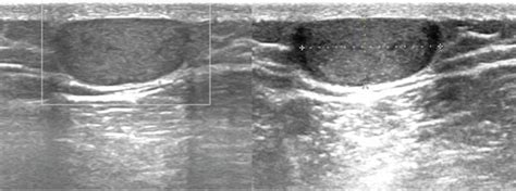 Sample Ultrasound Images Of Subcutaneous Cyst Download Scientific