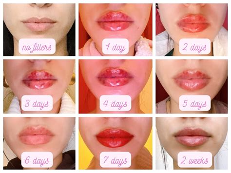 Follow Up Post 05ml Lip Fillers Day By Day Beforeafter R