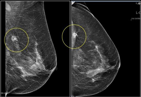 False Mammograms Are More Common Than You Think Dennis R Holmes Md