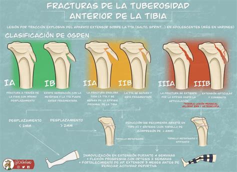 Fracturas De La Tuberosidad Anterior De La Tibia Ortopedia Y