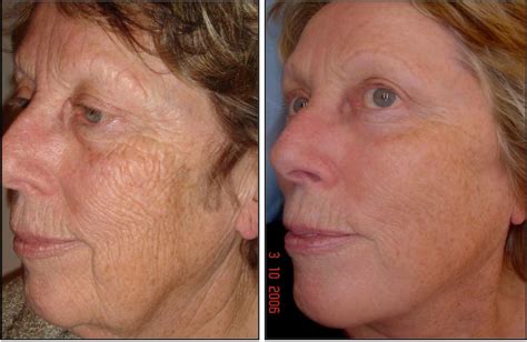 Fraxel Laser Resurfacing And Thermage Cpt In Okc Dr Tim Love