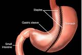 Images of Side Effects Of Gastric Bypass Years Later