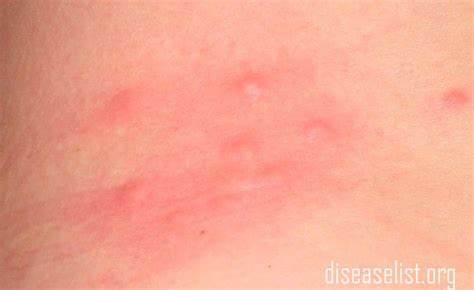 Itchy Skin Bumps Dorothee Padraig South West Skin Health Care