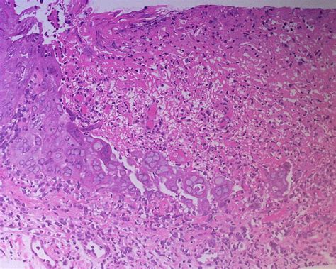 Herpetic Geometric Glossitis In An Immunocompetent Patient With