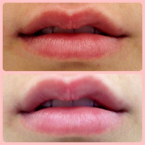 Subtle Lip Augmentation Is The Way To Start You Can Always Come Back