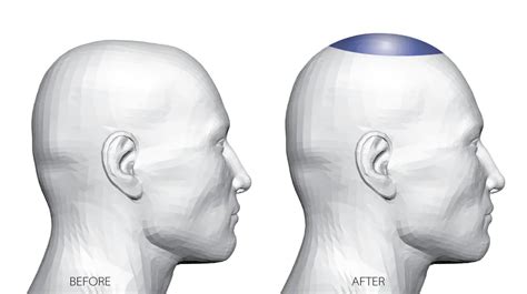 Sagittal Skull Reshaping Detail Page Line Plastic Surgery Center
