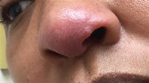 37 Year Old Female With Rash On Tip Of Nose The Doctors Channel