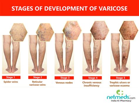 Varicose Eczema Causes Symptoms And Treatment