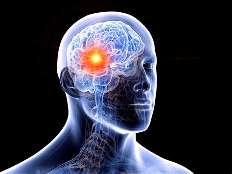 Brain Cancer Types Symptoms And Causes