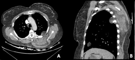Figure 1 From Chest Wall Resection For A Giant Angiomatosis Lesion A