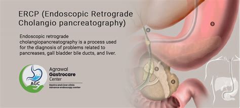 Endoscopic Retrograde Cholangio Pancreatography Ercp Test In Indore