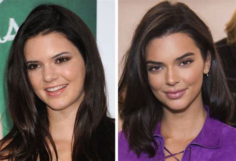 Celebrities Before Plastic Surgery 10 Pics Sharepics