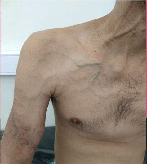 List Images Blue Veins On Chest And Shoulders Male Sharp