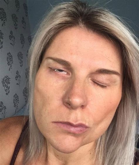 Nurse Woke Up Paralysed On One Side Of Face After Going To Bed With