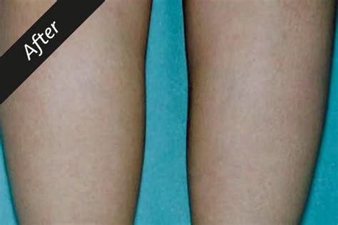 Common treatment locations include legs, armpits, upper lip, chin and the bikini line. Ellipse | Hair Removal - Ellipse