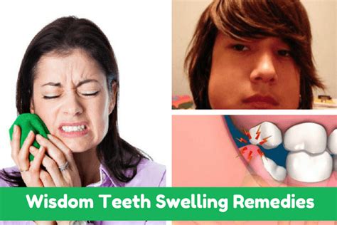 Wisdom Teeth Swelling Remedies Important Guide