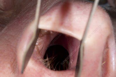 Perforated Nasal Septum Stock Image C Science Photo Library