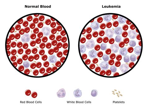 Sources of error in manual. Leukemia - OrthoInfo - AAOS
