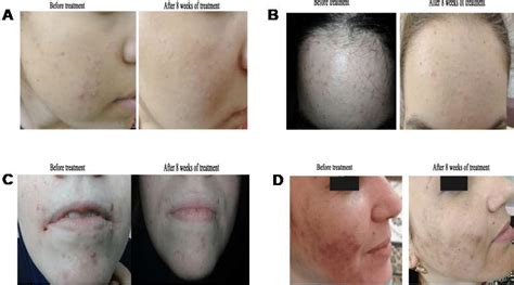 A Patient With Mild Acne Vulgaris In The Right Cheek Of 15 Years Old