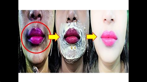 How To Remove Dark Black Spots Hyperpigmentation Around Your Mouth