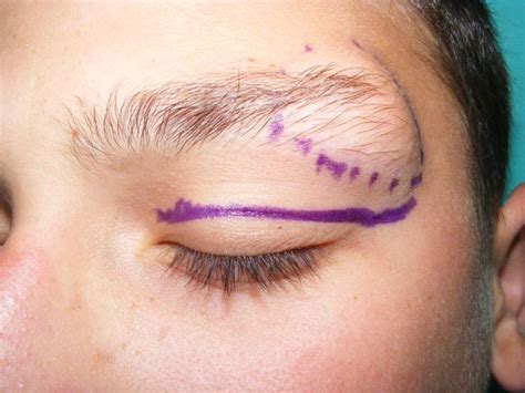 Excision Of Orbital Dermoid Cysts Via Upper Eyelid Incision A Review