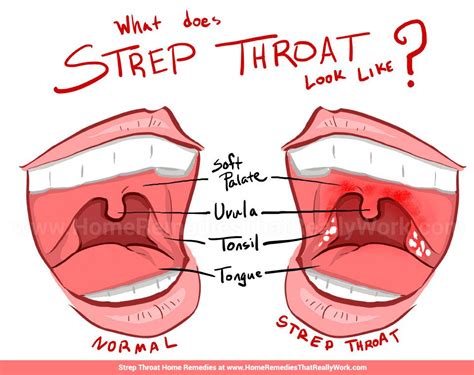 Strep Throat Home Remedies Garlic Salt And More Strep Throat Strep