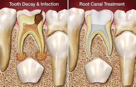 Maybe you would like to learn more about one of these? Burnaby Endodontics, Root Canals: 4800 Kingsway #359