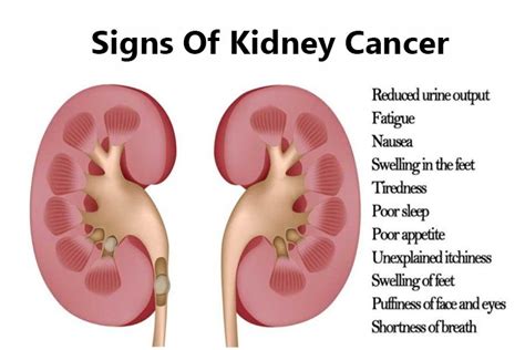 People with kidney cancer may experience the following symptoms or signs. What Is Kidney Cancer ? How To Prevent Kidney Problems ...