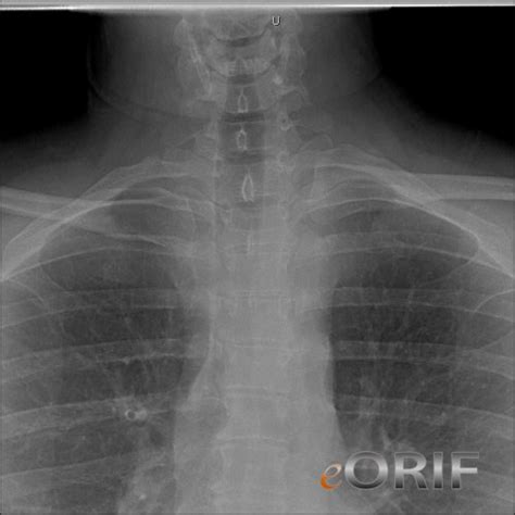 Sternoclavicular Joint Dislocation S43.206A 839.61 | eORIF