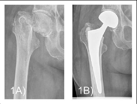 A Example Of A Dorr Type C Proximal Femur B Primary Cemented
