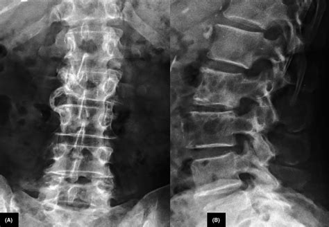 Anteroposterior A And Lateral B Radiographs Of Lumbar Spine Mixed