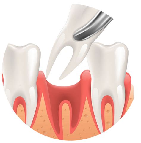 Visit Zoma Dental for Tooth Extractions in West Bloomfield