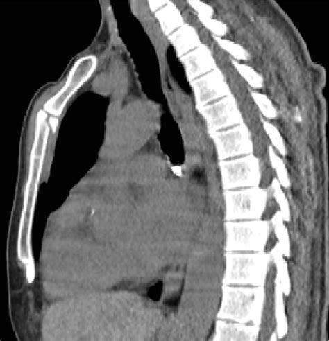Figure 2 From Are Sternum Fractures Really Indicative Of Severe Trauma
