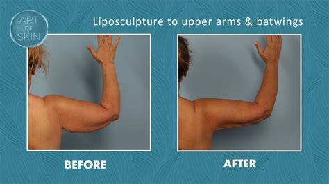 Laser Liposuction Of Upper Arms And Batwings Youtube