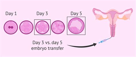 Embryo Transfer On Day 3 Or On Day 5 Invitra