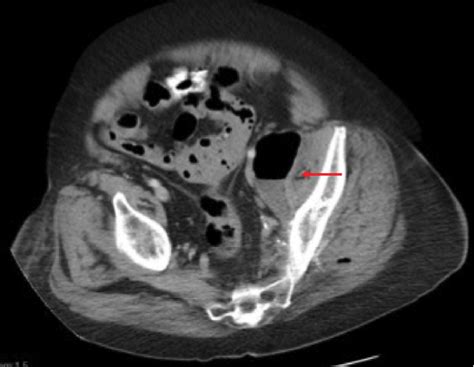 Initial Ct Scan Showing Abscess With Air Fluid Level Abutting Left